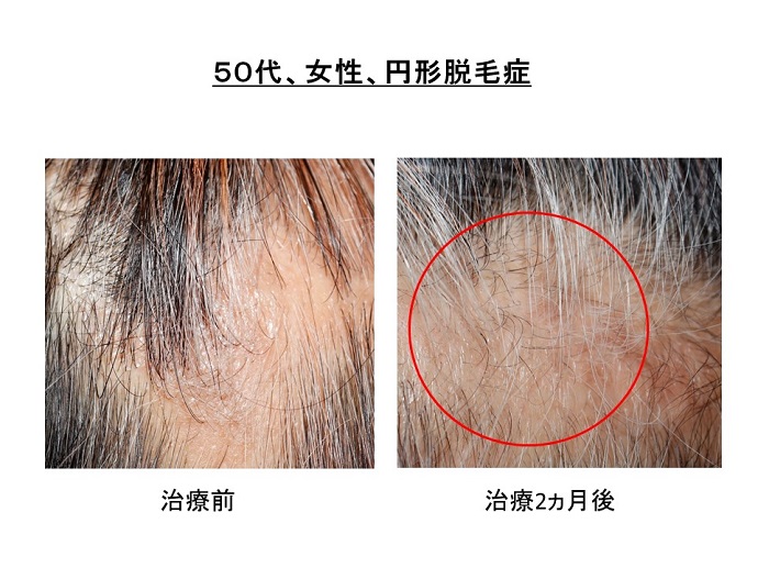 円形脱毛症　病院